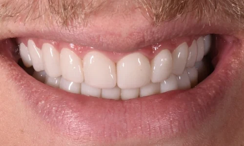 After: a full set of even, white crowns.
