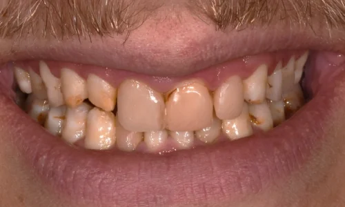 Before: discolored, pitted and uneven teeth.