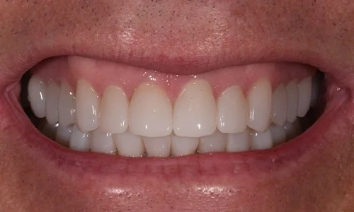 After: bright, evenly shaped crowns across the smile.