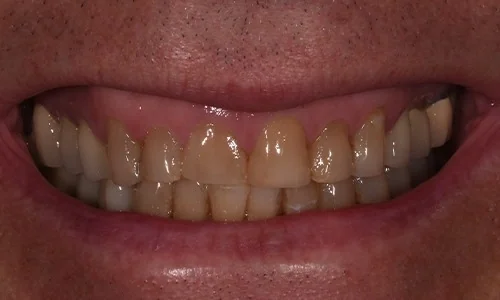 Before: worn, yellowed and uneven front teeth.