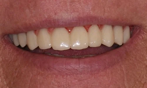 After: an even, fixed upper arch on implants.