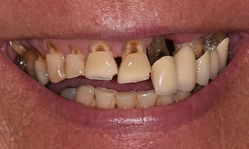 Before: worn, broken and missing upper teeth.