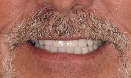 After: a complete, even set of new teeth.