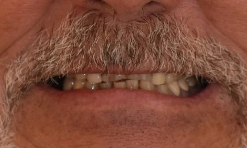 Before: worn and darkened teeth beneath a moustache.